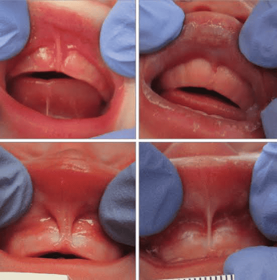 Clinical examples of upper labial lip tie