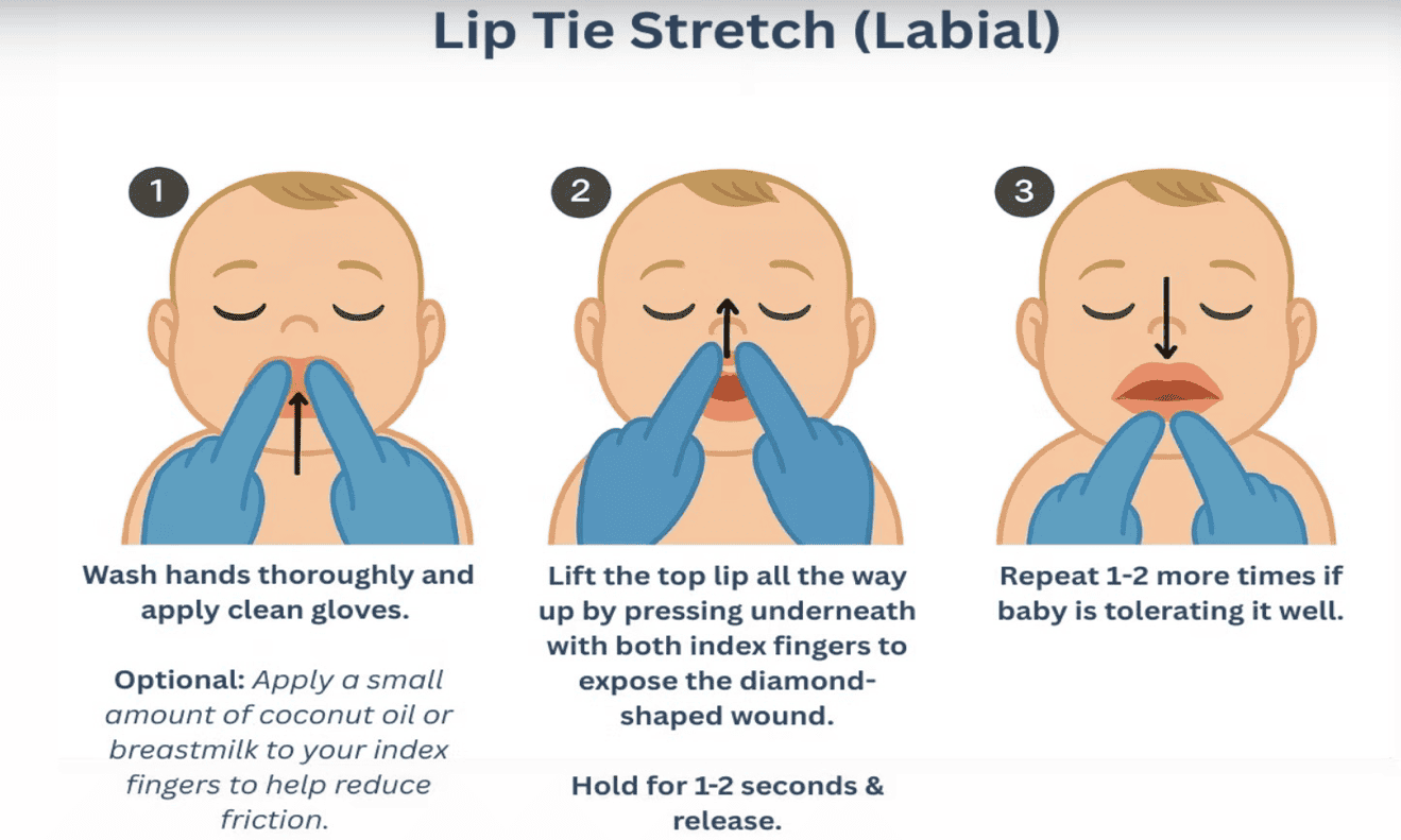 Diagram of the three steps of the labial lip-tie stretch technique