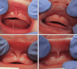 Tongue and Lip Tie Management