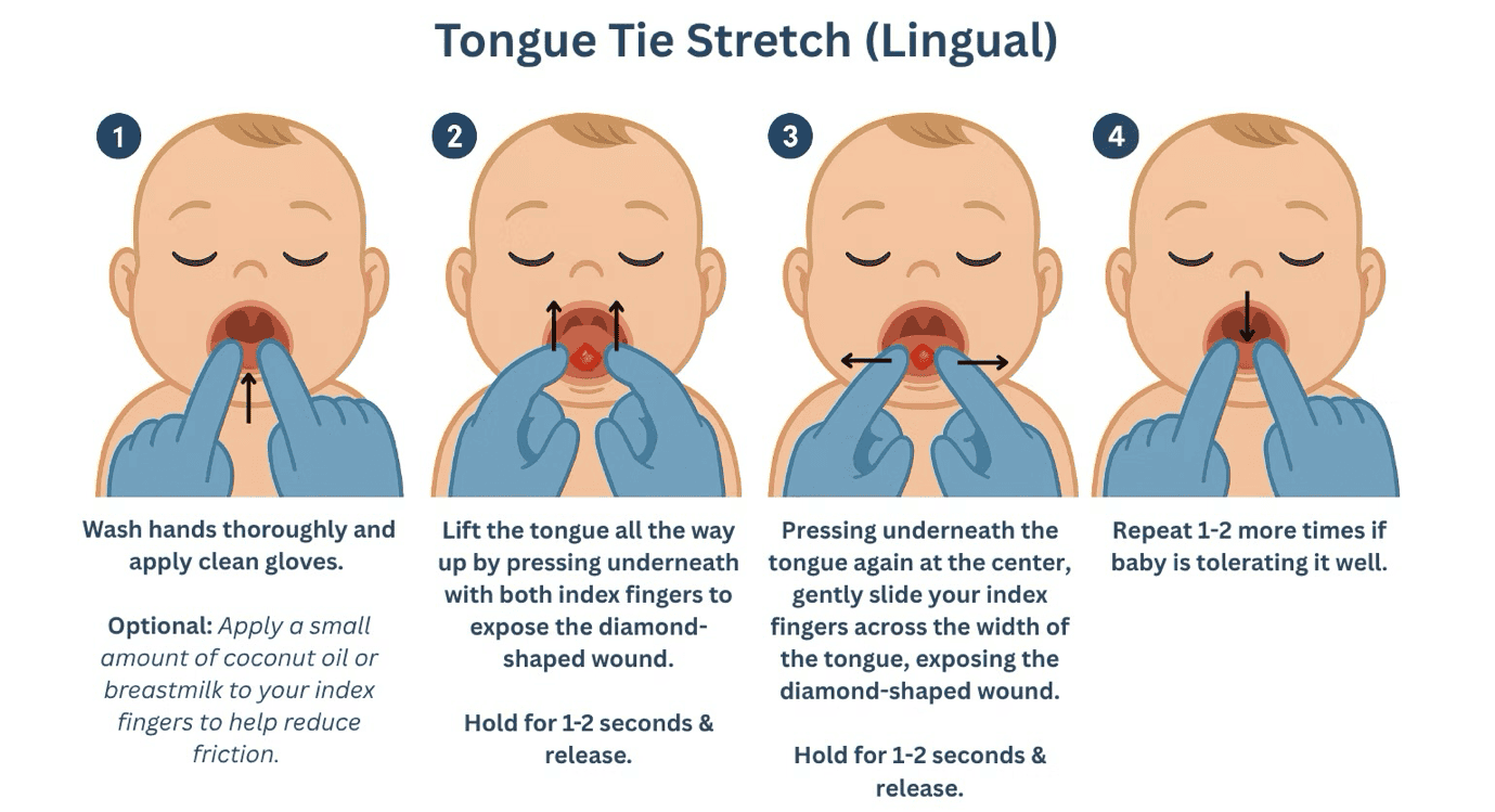 Diagram of the four steps of the lingual tongue-tie stretch technique