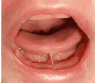 Clinical photo of Type I anterior tongue tie