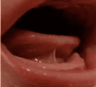 Clinical photo of Type II tongue tie