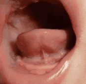 Clinical photo of Type III tongue tie