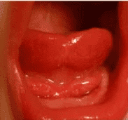 Clinical photo of Type IV posterior tongue tie