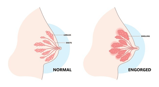 Diagram comparing a normal breast to an engorged breast