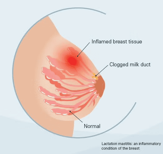 Diagram showing normal breast tissue, a clogged milk duct, and inflamed breast tissue in lactation mastitis