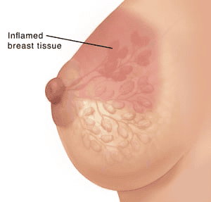 Illustration of inflamed breast tissue during mastitis