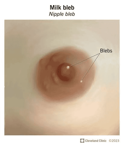Close-up photo of a milk bleb (nipple bleb) on the nipple