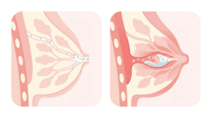 Breast Conditions Infographics